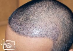 -大麦微针植发丨全国连锁