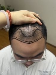 体验前-大麦微针植发全国连锁