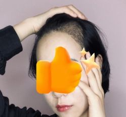 -大麦微针植发丨全国连锁