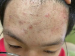 体验前-元熙兰积皮肤管理