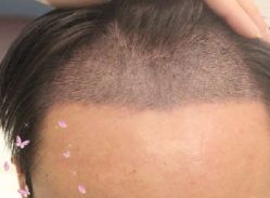 -大麦微针植发丨全国连锁