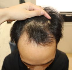 -大麦微针植发丨全国连锁