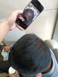 -碧莲盛·不剃发植发