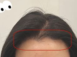 -大麦微针植发全国连锁