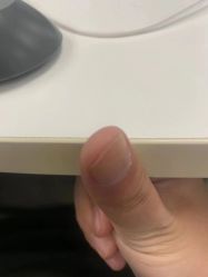 -德哥灰指甲脚气甲沟炎跖疣护理