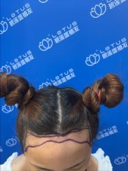 -碧莲盛·不剃发植发