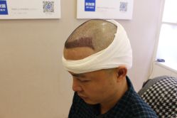 -大麦微针植发丨全国连锁