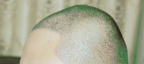-大麦微针植发丨全国连锁