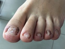 -德哥灰指甲脚气甲沟炎跖疣护理