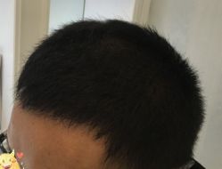 -大麦微针植发丨全国连锁