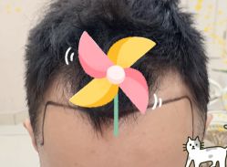 -大麦微针植发全国连锁