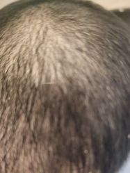 -碧莲盛·不剃发植发