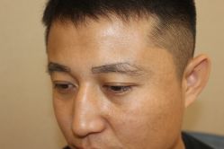 -大麦微针植发丨全国连锁