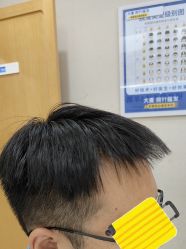 点击看大图 体验后-大麦微针植发丨全国连锁
