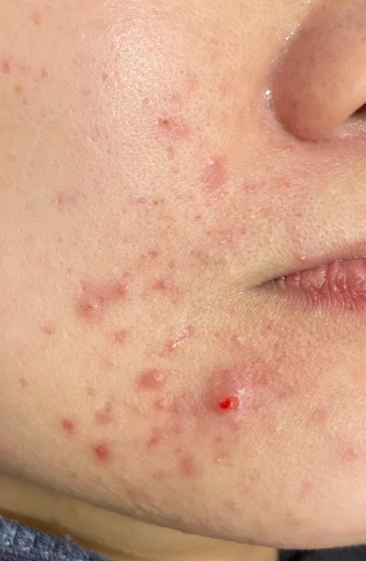 痘痘肌先辨别好什么问题导致的长痘