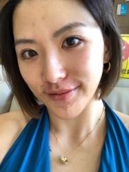 体验后-北京米扬丽格医疗美容·联合丽格鼻整形中心