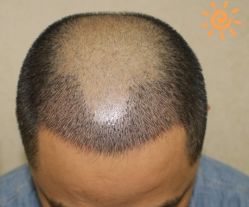 -大麦微针植发丨全国连锁