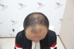 -大麦微针植发丨全国连锁
