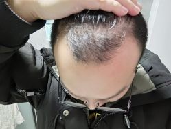 -大麦微针植发全国连锁