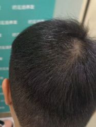 -碧莲盛·不剃发植发
