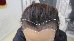 -大麦微针植发丨全国连锁