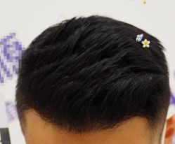 -大麦微针植发全国连锁