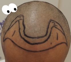 -大麦微针植发全国连锁