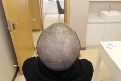 点击看大图 -大麦微针植发丨全国连锁