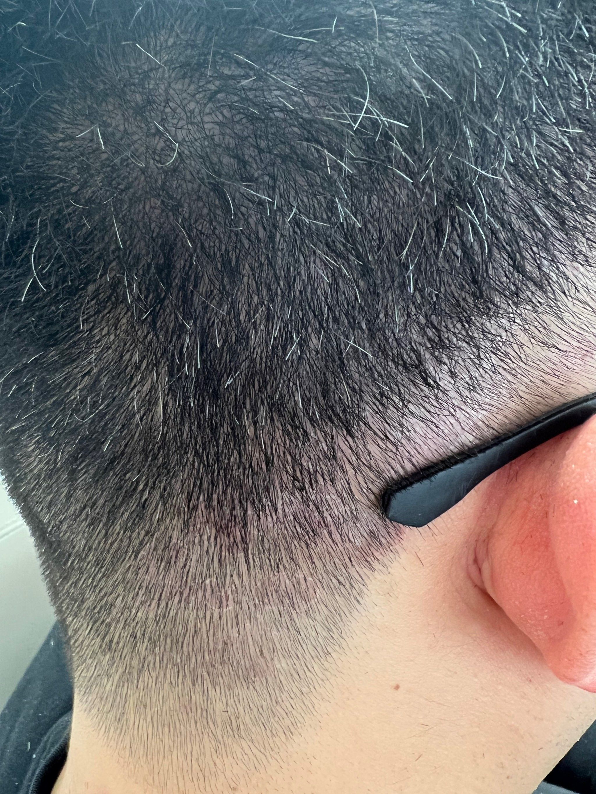 头癣怎么办?「gh头部健康生活馆」#解决所有头皮头发问题