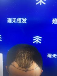 -雍禾植发全国连锁