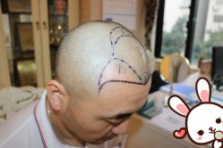 点击看大图 -大麦微针植发丨全国连锁