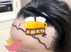 -大麦微针植发全国连锁