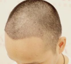 -大麦微针植发全国连锁