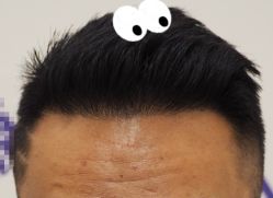 -大麦微针植发全国连锁