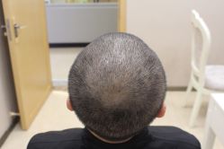 -大麦微针植发丨全国连锁