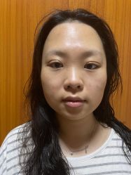 -广州健丽·去眼袋医疗美容机构