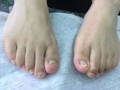 -德哥灰指甲脚气甲沟炎跖疣护理