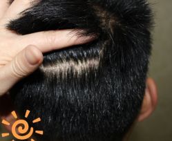 -大麦微针植发丨全国连锁