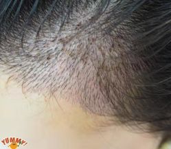 -大麦微针植发丨全国连锁