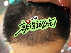 -大麦微针植发全国连锁