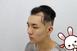 -大麦微针植发丨全国连锁