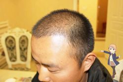 -大麦微针植发丨全国连锁