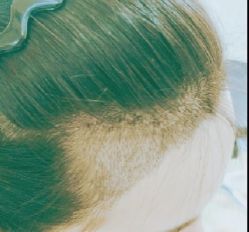 -大麦微针植发丨全国连锁