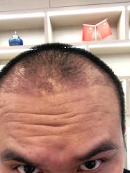 -大麦微针植发丨全国连锁