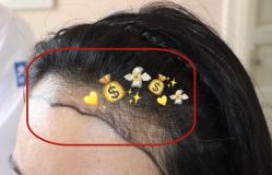 -大麦微针植发全国连锁