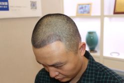 点击看大图 -大麦微针植发丨全国连锁