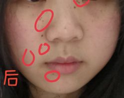 -痣缘宫