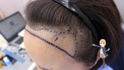 -大麦微针植发丨全国连锁