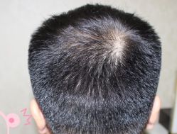 -大麦微针植发丨全国连锁