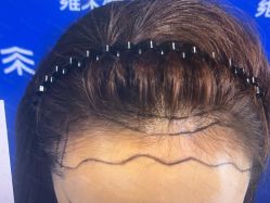 体验前-雍禾植发全国连锁